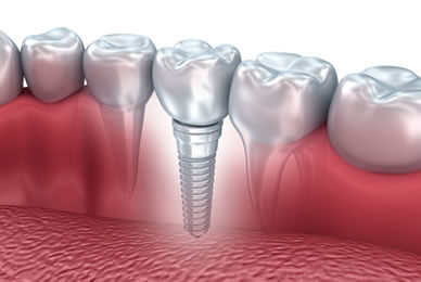 1000oaks Dental & Implants