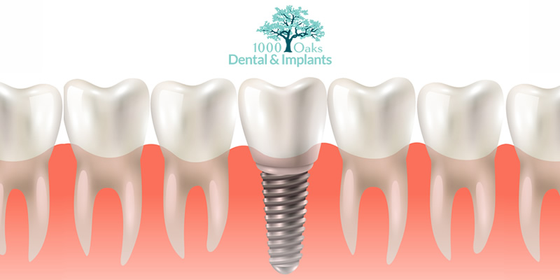 Benefits & Types of Dental Implants