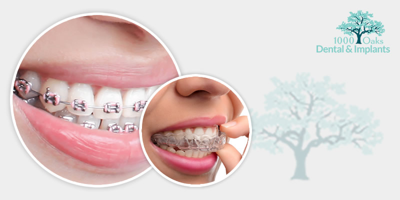 Invisalign vs Metal Braces Select The Perfect One For You!
