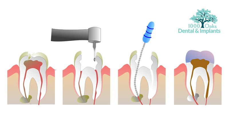 Why Do I Need A Root Canal If My Tooth Doesn't Hurt
