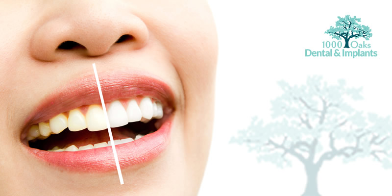 Teeth Whitening: Do Whitening Strips Work? - 1000oaks Dental & Implants: Dentists: Thousand Oaks, CA Teeth Whitening: Do Whitening Strips Work? - 1000oaks Dental & Implants: Dentists: Thousand Oaks, CA
